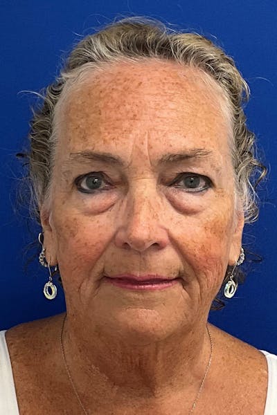 Facelift Before & After Gallery - Patient 259526 - Image 1