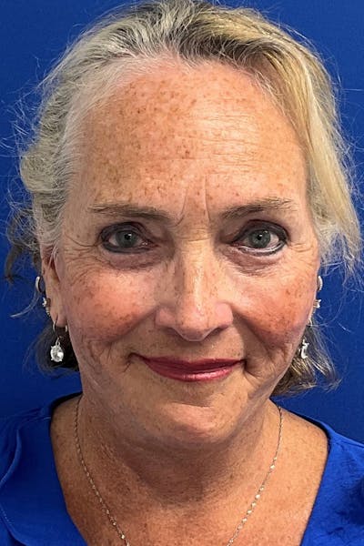 Facelift Before & After Gallery - Patient 259526 - Image 2
