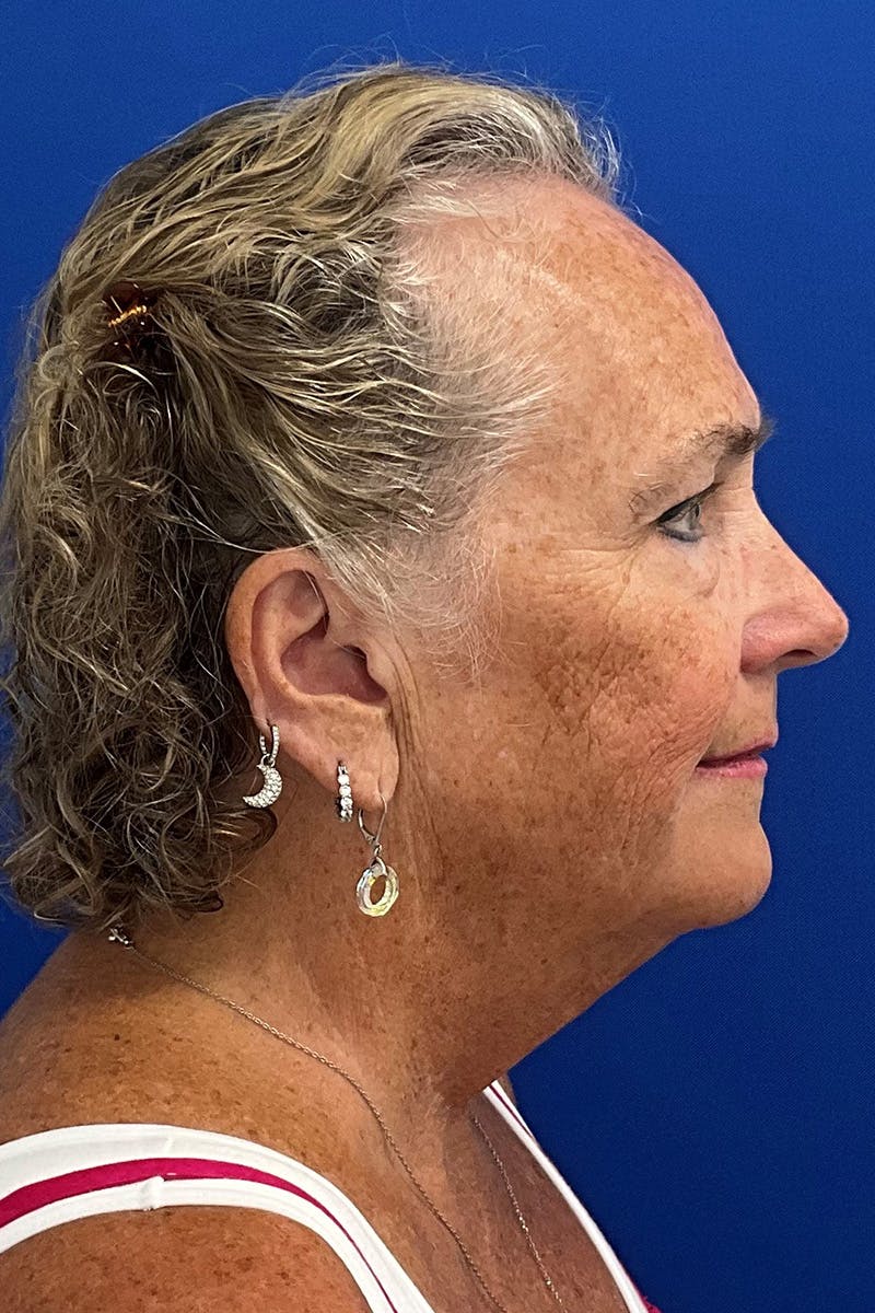 Facelift Before & After Gallery - Patient 259526 - Image 3