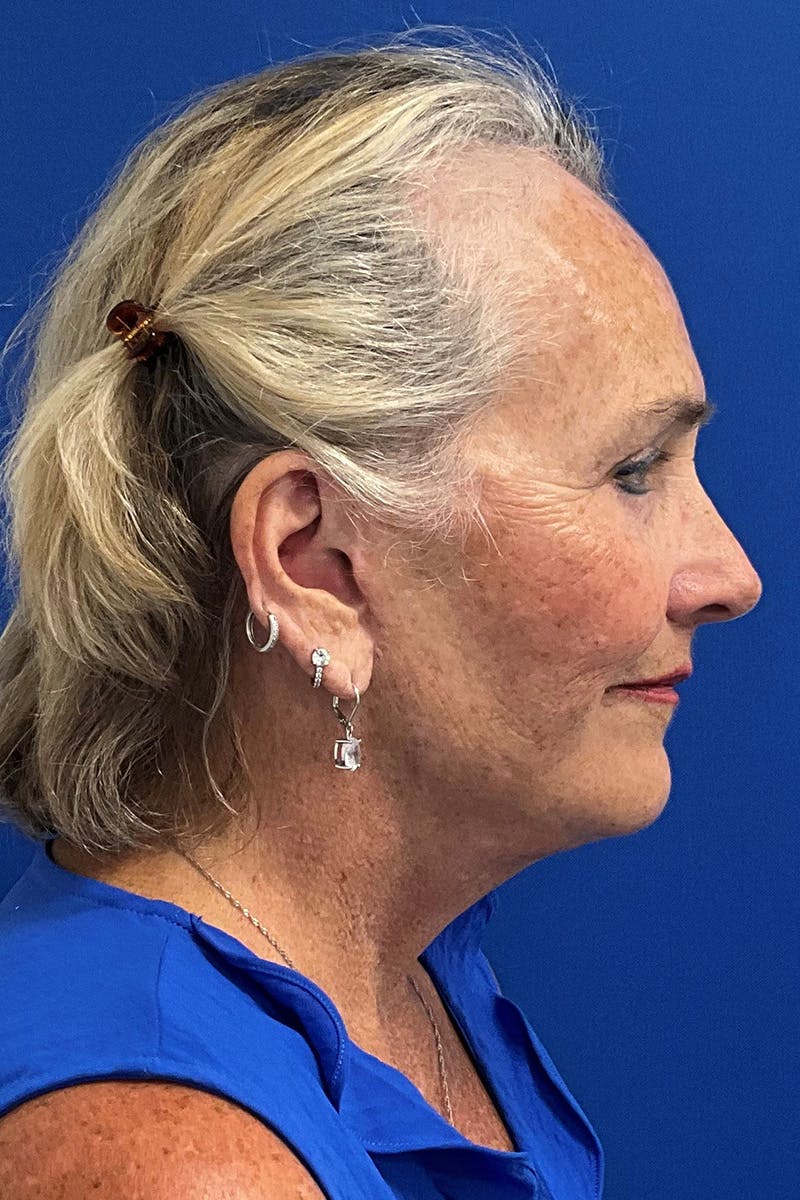 Facelift Before & After Gallery - Patient 259526 - Image 4