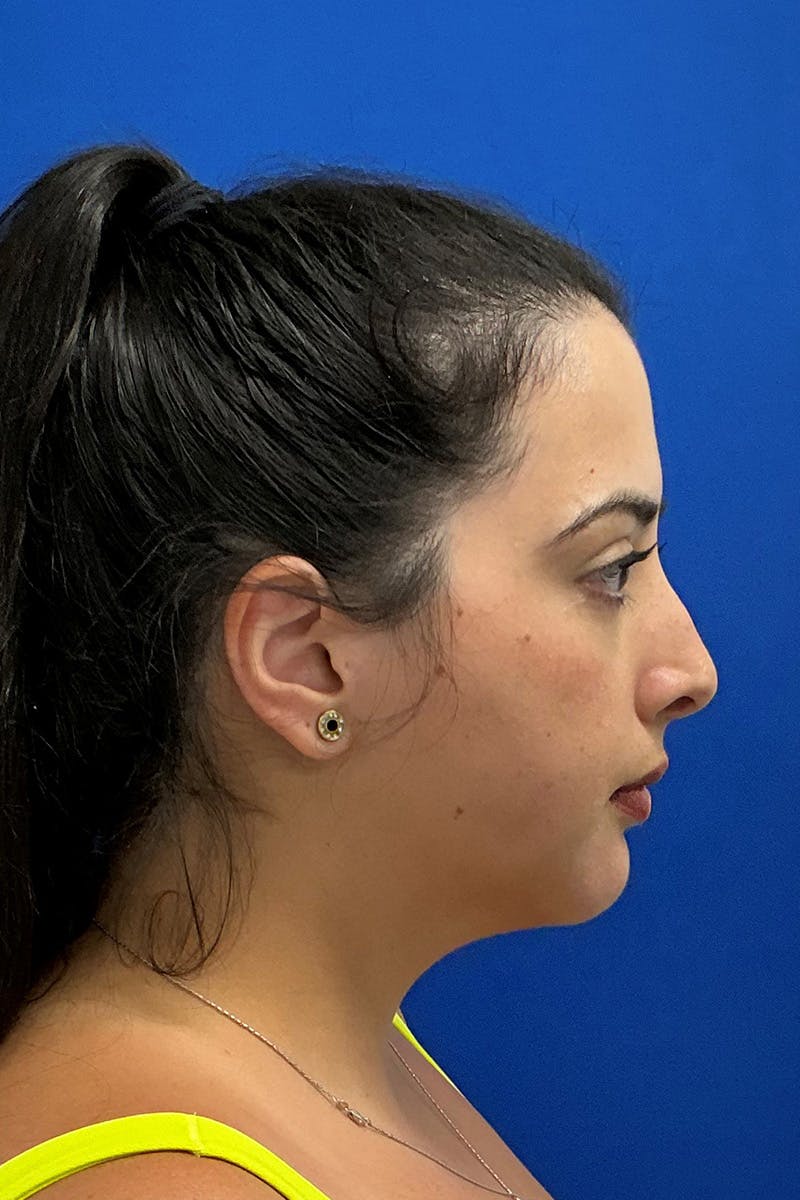 Genioplasty (Chin Augmentation) Before & After Gallery - Patient 293064 - Image 2