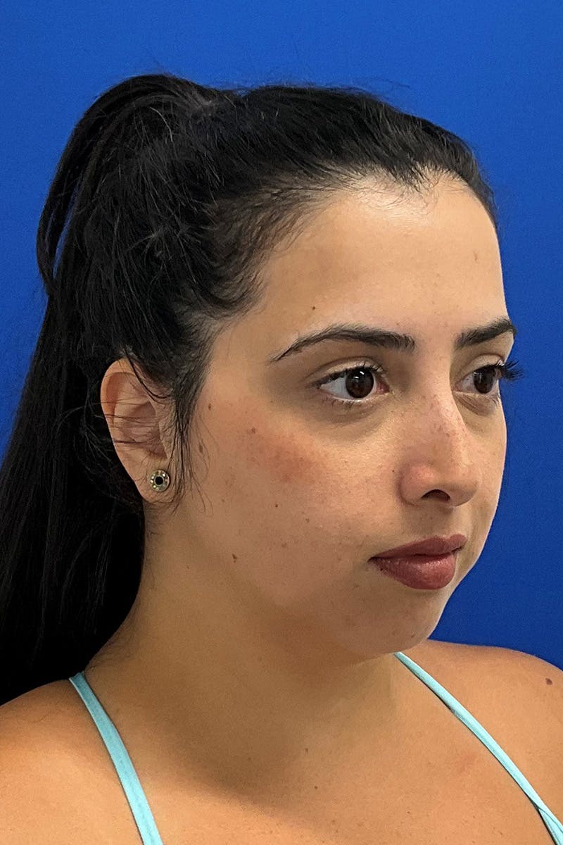 Genioplasty (Chin Augmentation) Before & After Gallery - Patient 293064 - Image 3