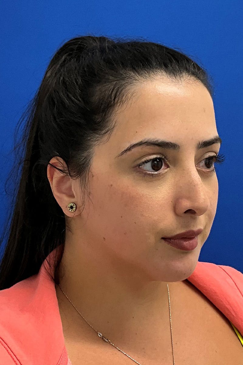 Genioplasty (Chin Augmentation) Before & After Gallery - Patient 293064 - Image 4