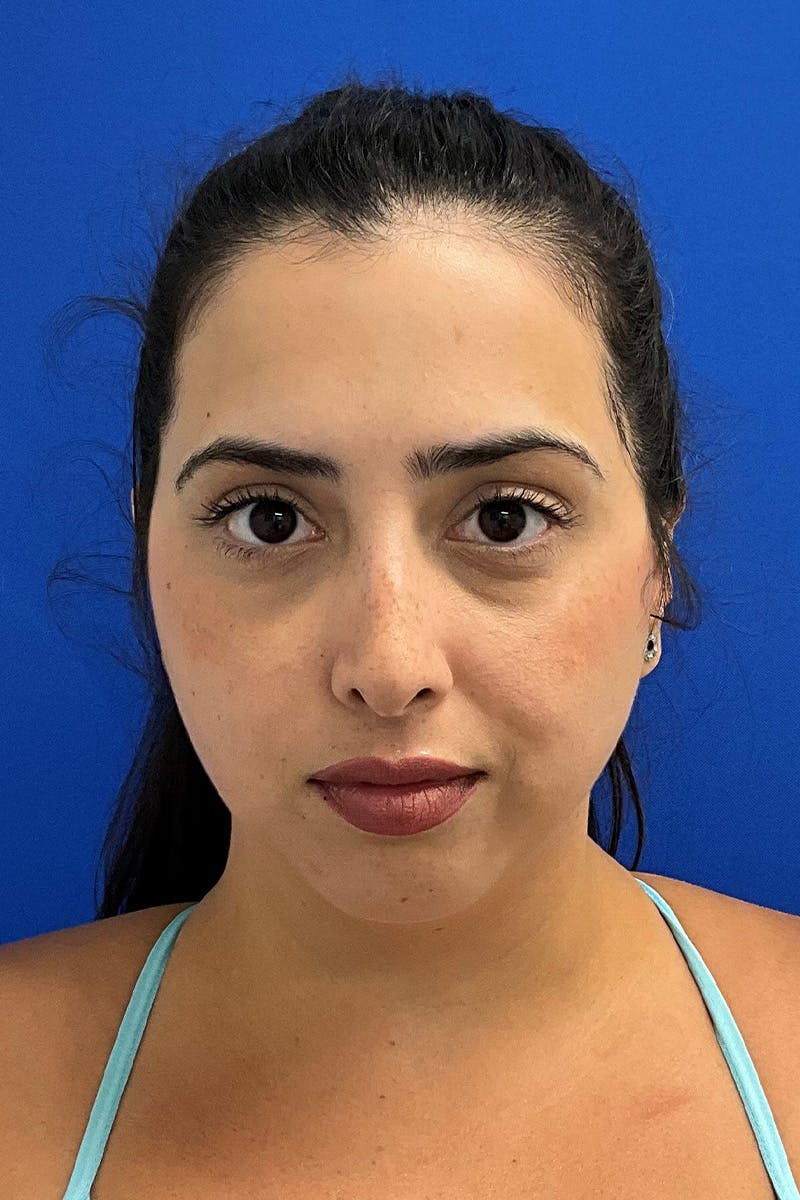 Genioplasty (Chin Augmentation) Before & After Gallery - Patient 293064 - Image 5