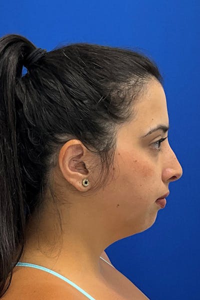 Genioplasty (Chin Augmentation) Before & After Gallery - Patient 293064 - Image 1