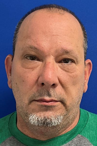 Blepharoplasty Before & After Gallery - Patient 365554 - Image 1