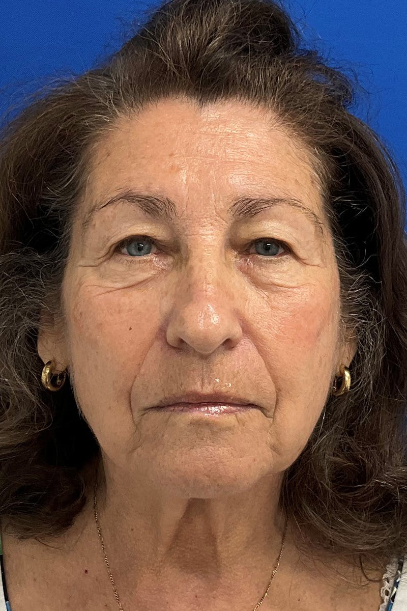 Blepharoplasty Before & After Gallery - Patient 843567 - Image 1
