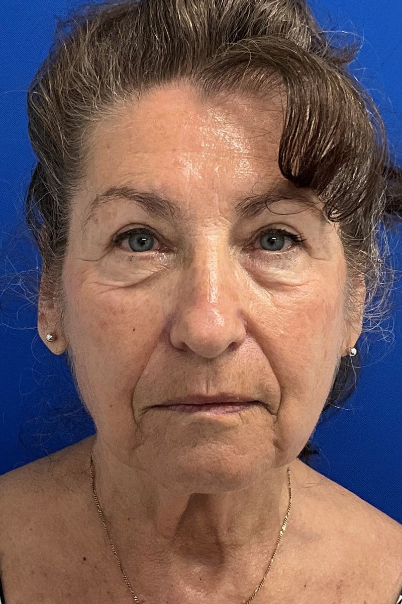 Blepharoplasty Before & After Gallery - Patient 843567 - Image 2