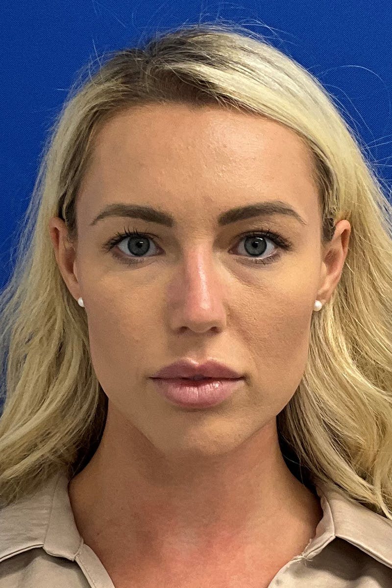 Blepharoplasty Before & After Gallery - Patient 199810 - Image 1