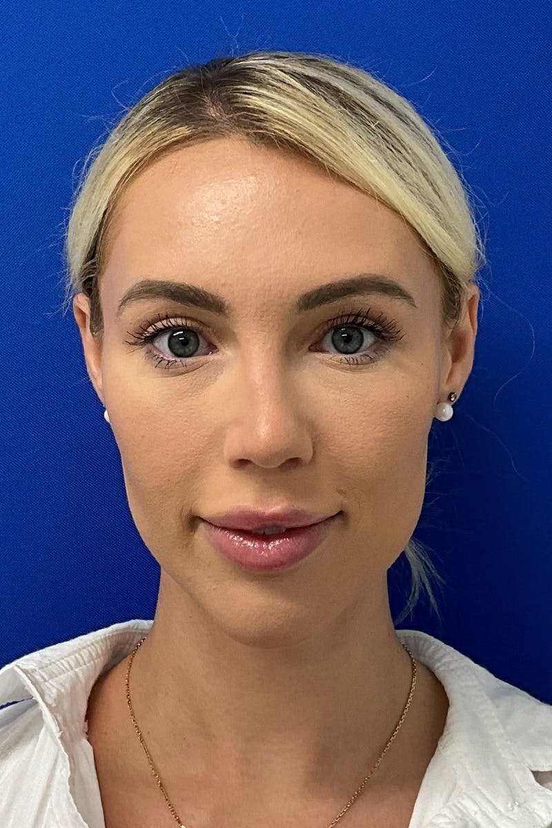 Blepharoplasty Before & After Gallery - Patient 199810 - Image 2