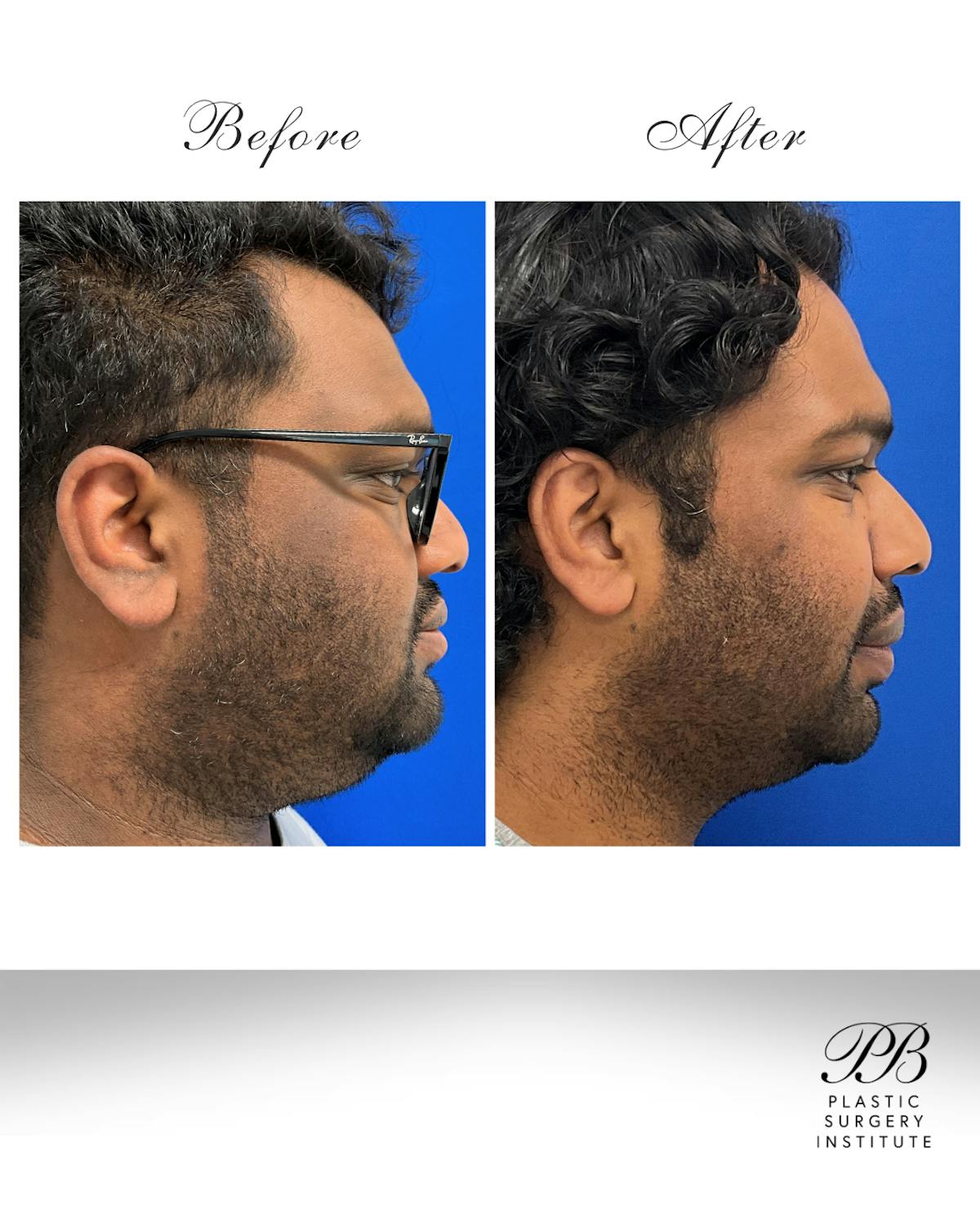Orthognathic (Jaw) Surgery Before & After Gallery - Patient 157437 - Image 2