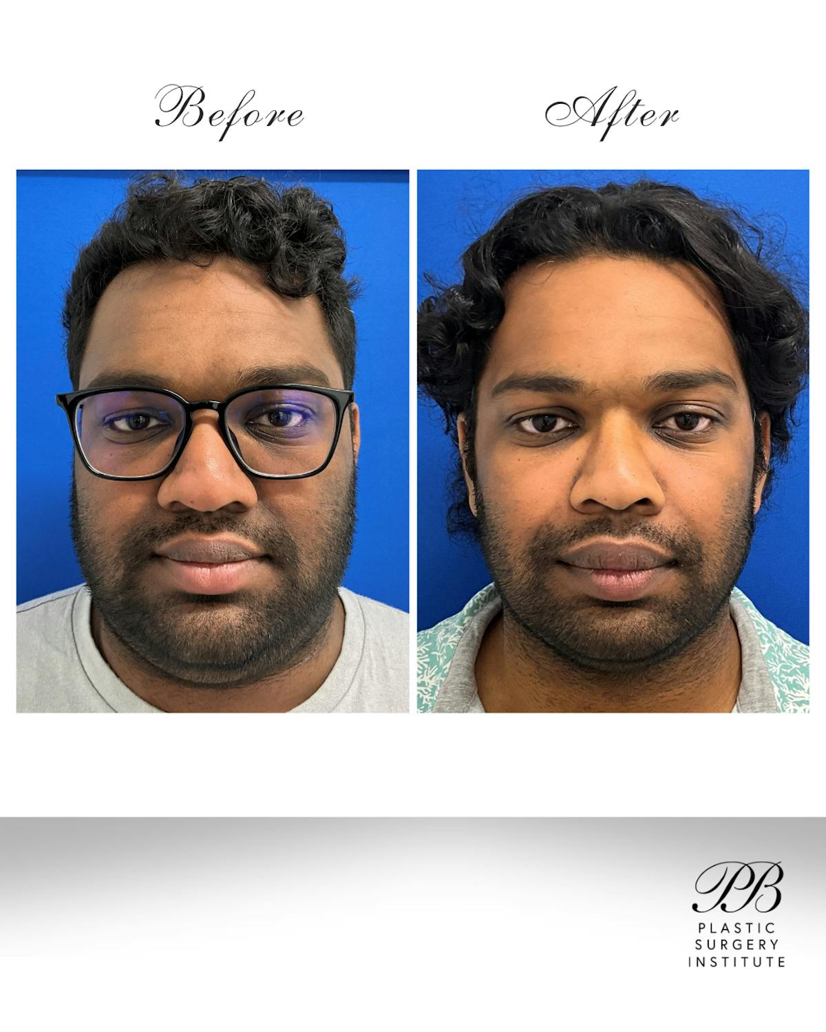 Orthognathic (Jaw) Surgery Before & After Gallery - Patient 157437 - Image 1