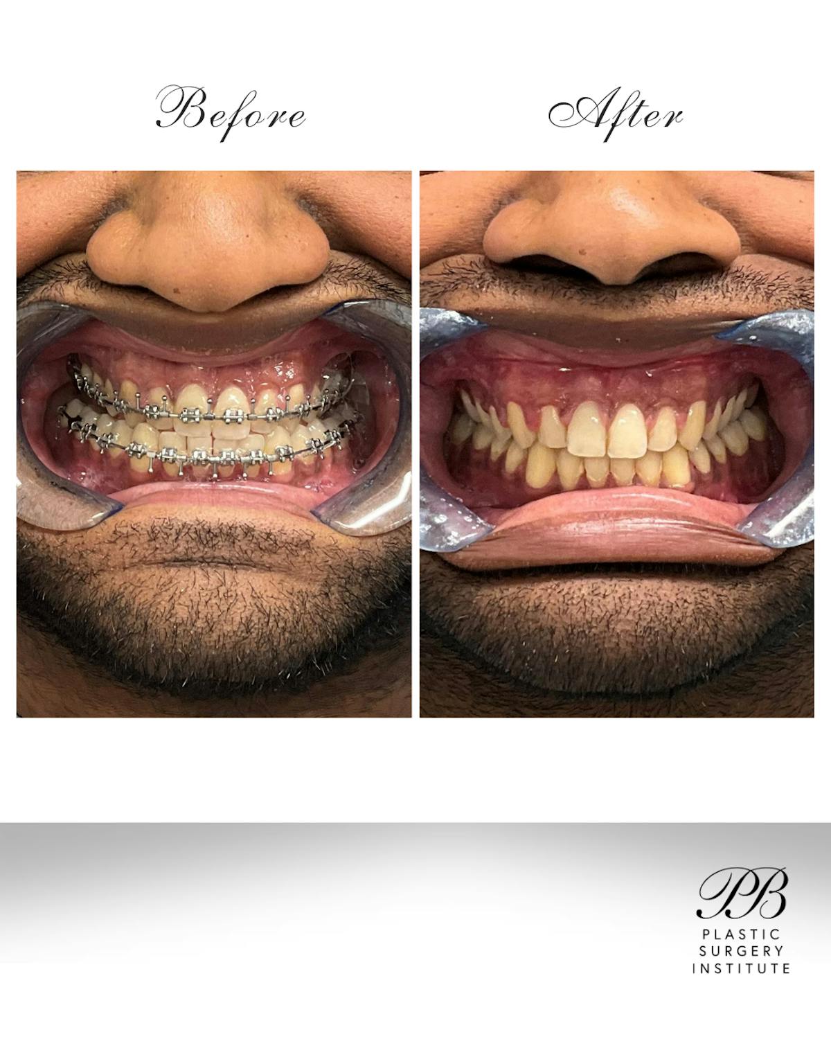 Orthognathic (Jaw) Surgery Before & After Gallery - Patient 157437 - Image 3