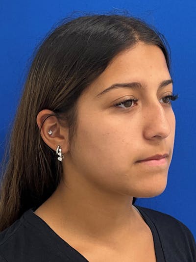 Rhinoplasty Before & After Gallery - Patient 404162 - Image 1