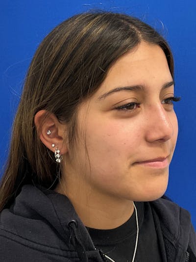Rhinoplasty Before & After Gallery - Patient 404162 - Image 2