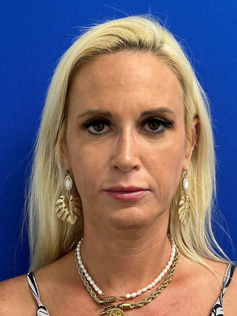 Rhinoplasty Before & After Gallery - Patient 236975 - Image 4