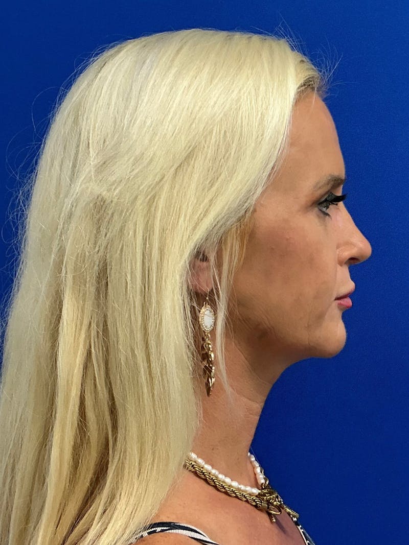 Rhinoplasty Before & After Gallery - Patient 236975 - Image 6