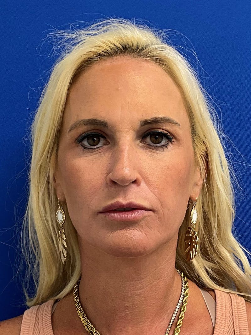 Rhinoplasty Before & After Gallery - Patient 236975 - Image 3