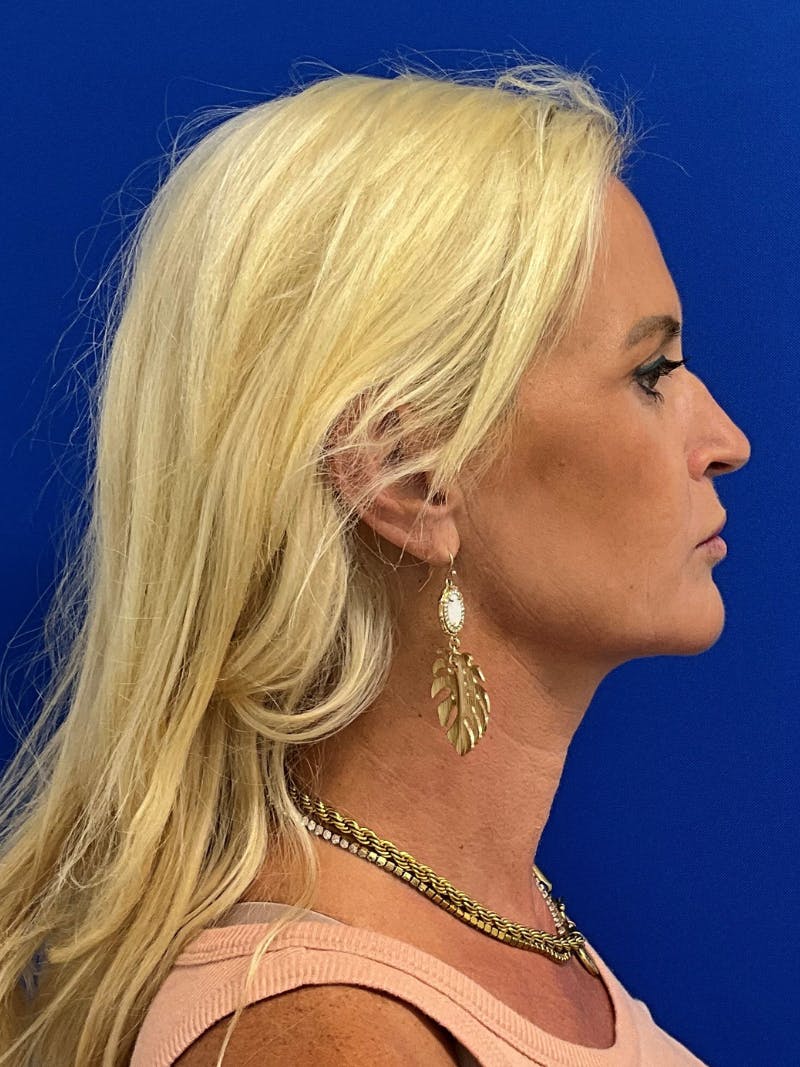 Rhinoplasty Before & After Gallery - Patient 236975 - Image 5