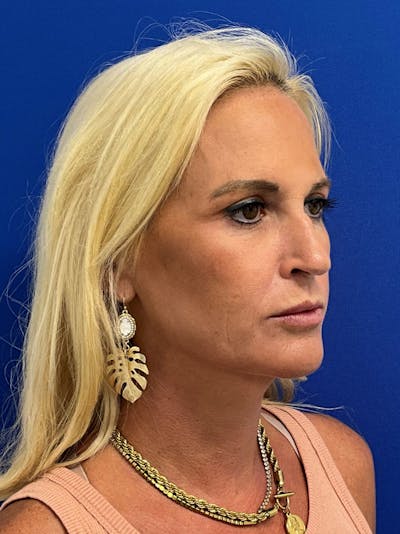 Rhinoplasty Before & After Gallery - Patient 236975 - Image 1
