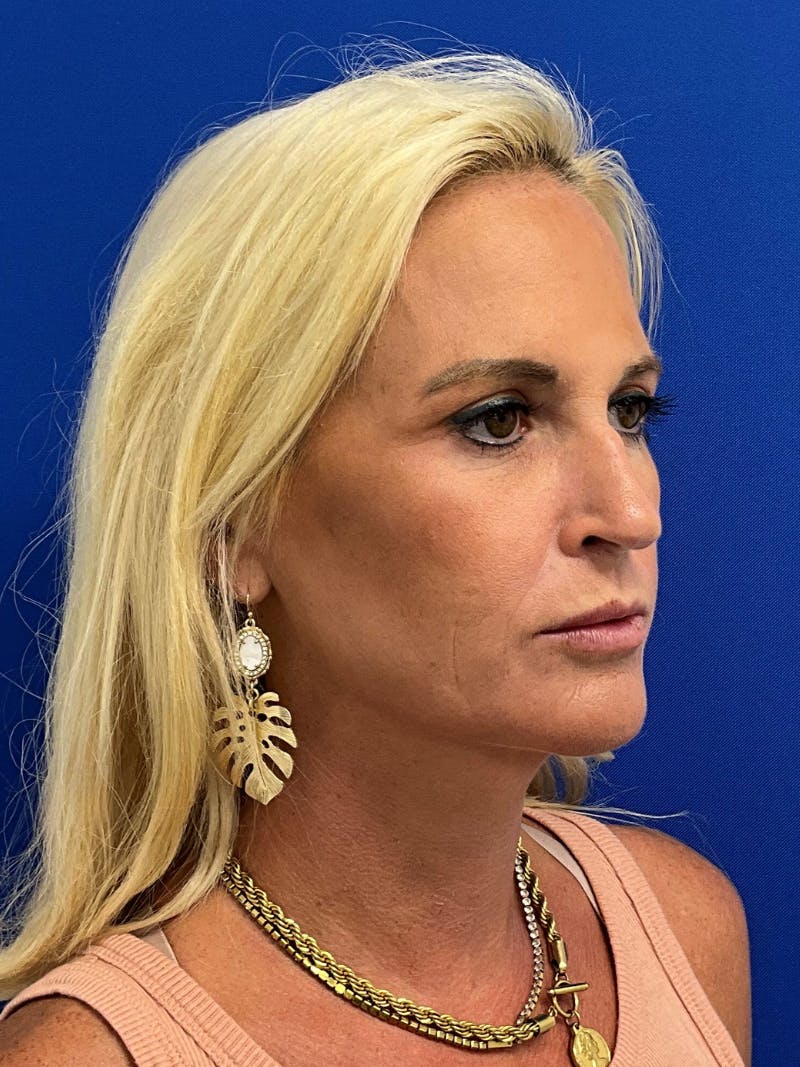 Rhinoplasty Before & After Gallery - Patient 236975 - Image 1