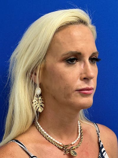 Rhinoplasty Before & After Gallery - Patient 236975 - Image 2