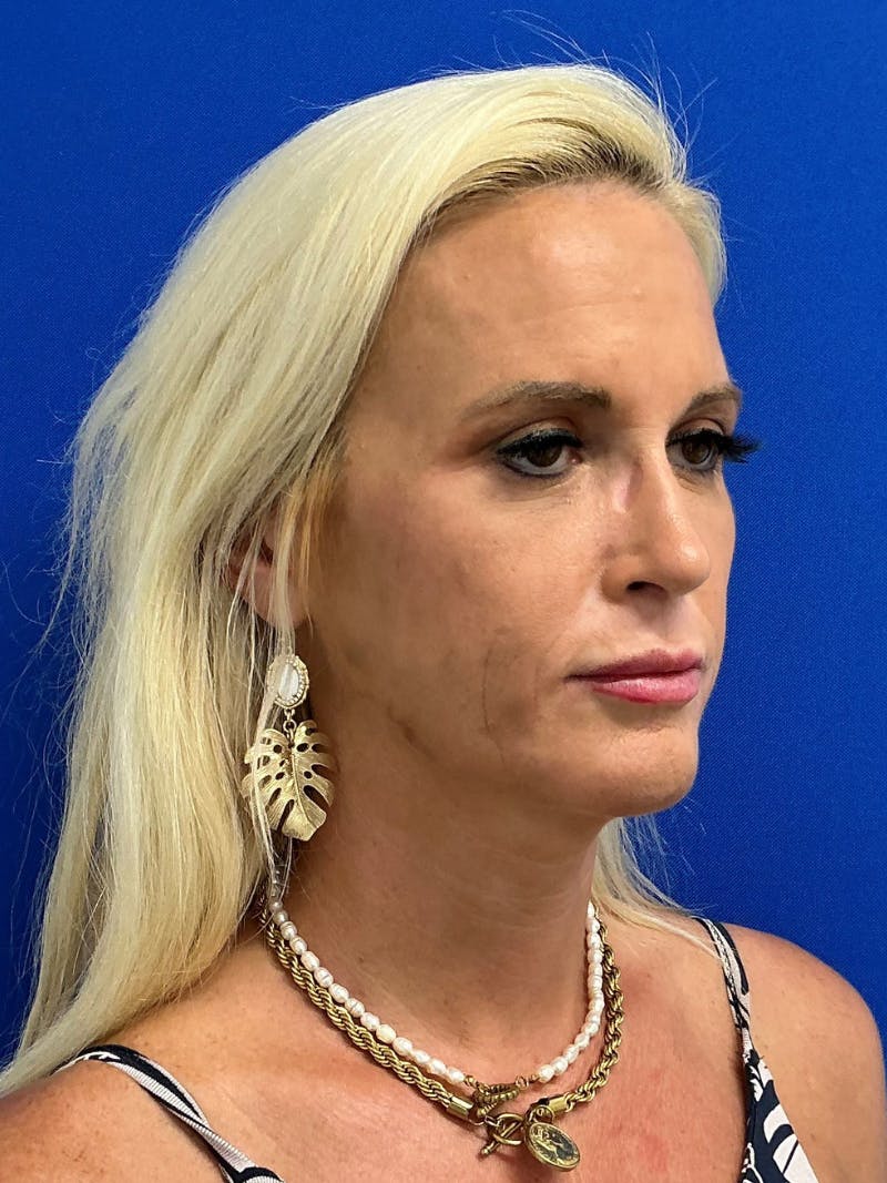 Rhinoplasty Before & After Gallery - Patient 236975 - Image 2