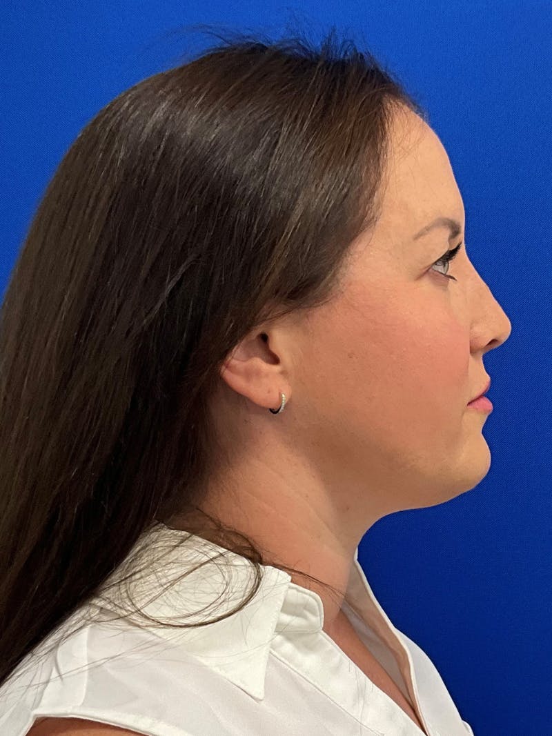 Rhinoplasty Before & After Gallery - Patient 381822 - Image 6