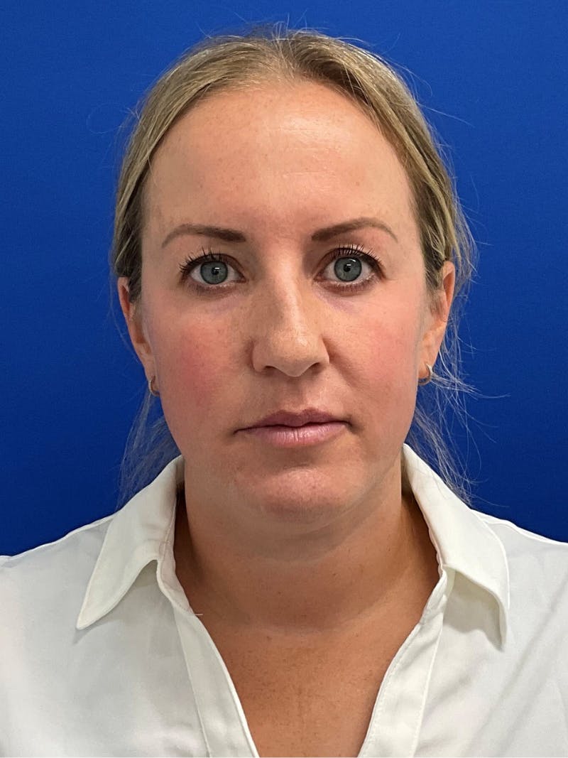 Rhinoplasty Before & After Gallery - Patient 381822 - Image 3