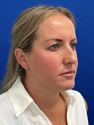 Rhinoplasty Before & After Gallery - Patient 381822 - Image 1