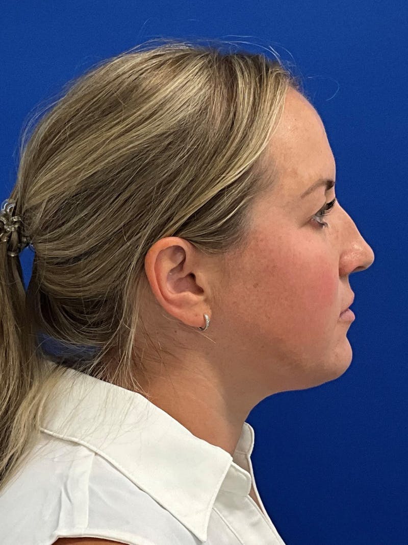 Rhinoplasty Before & After Gallery - Patient 381822 - Image 5