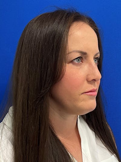 Rhinoplasty Before & After Gallery - Patient 381822 - Image 2