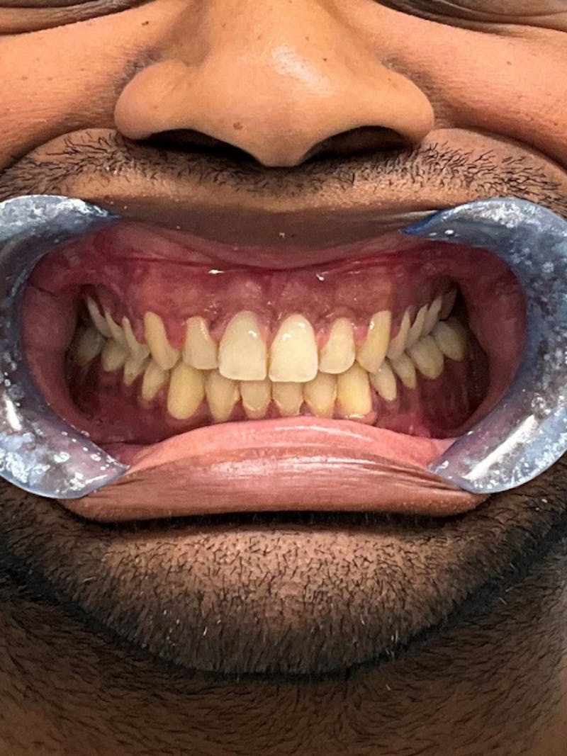 Orthognathic (Jaw) Surgery Before & After Gallery - Patient 157437 - Image 6