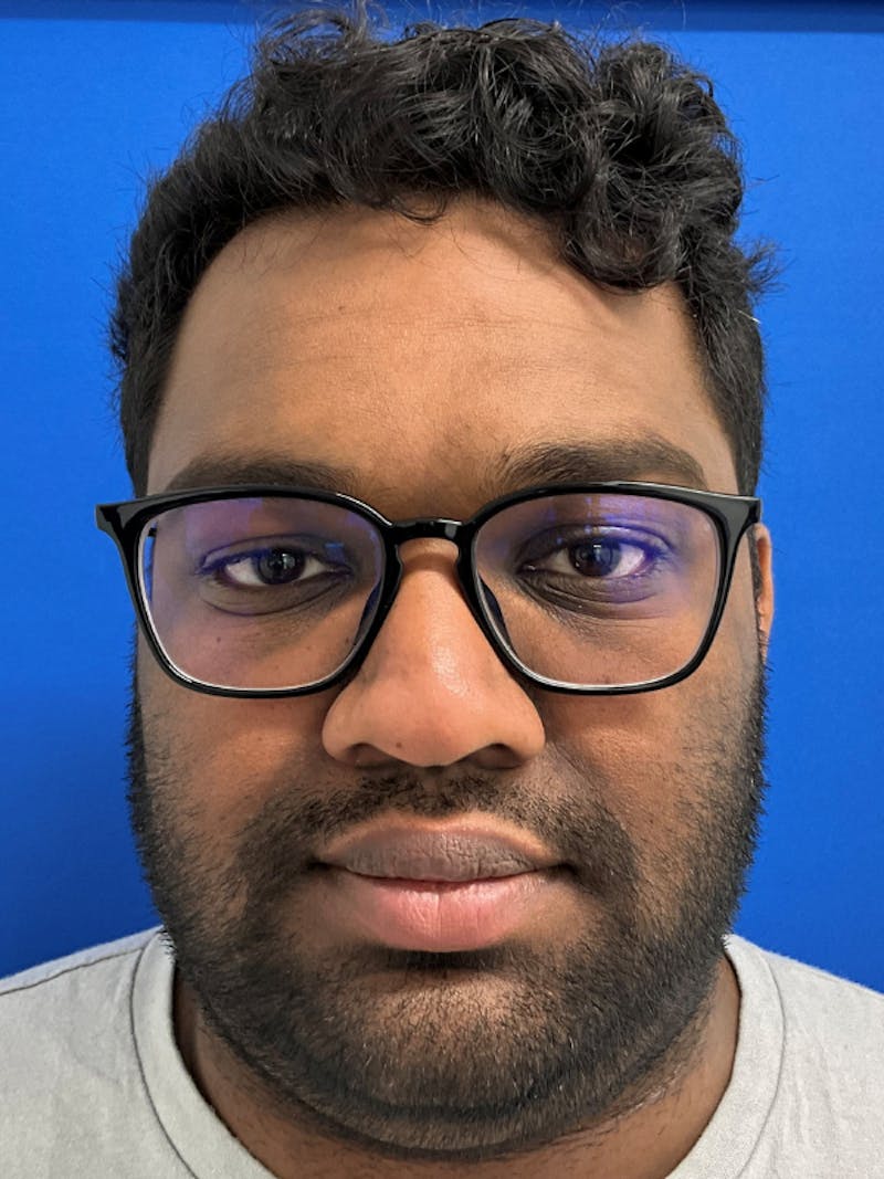 Orthognathic (Jaw) Surgery Before & After Gallery - Patient 157437 - Image 1