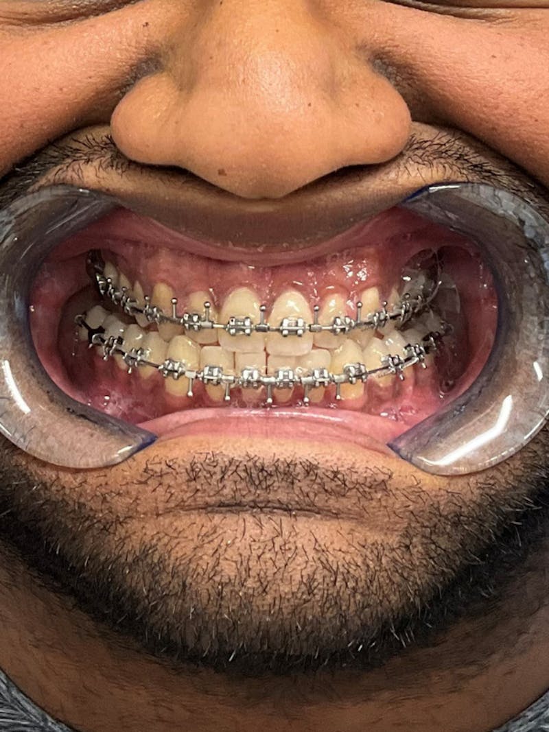 Orthognathic (Jaw) Surgery Before & After Gallery - Patient 157437 - Image 5