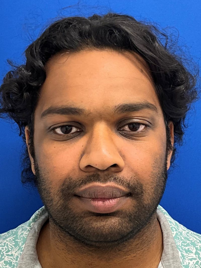 Orthognathic (Jaw) Surgery Before & After Gallery - Patient 157437 - Image 2