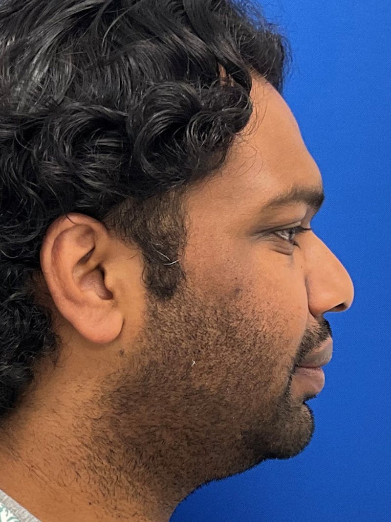 Orthognathic (Jaw) Surgery Before & After Gallery - Patient 157437 - Image 4
