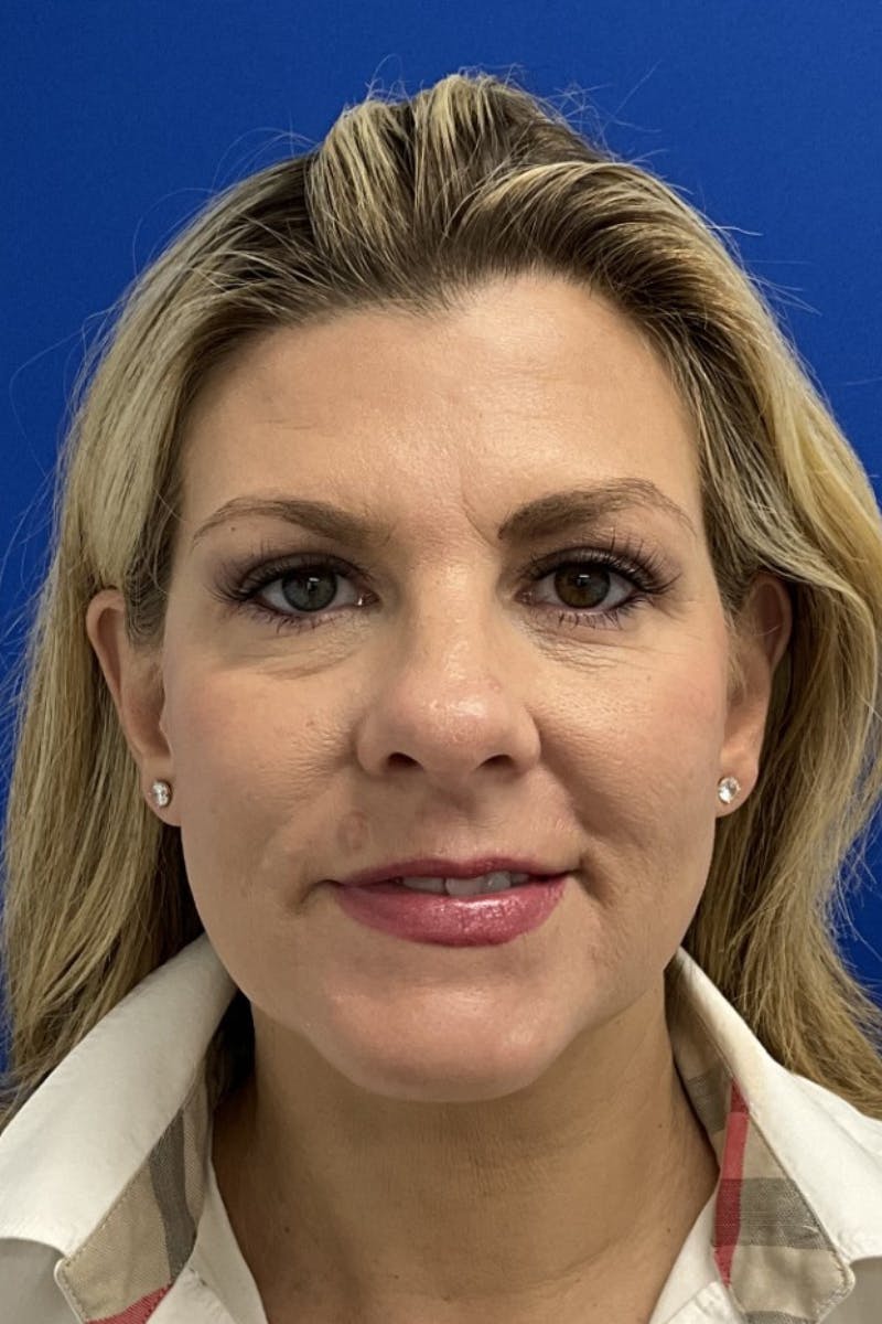 Blepharoplasty Before & After Gallery - Patient 107288 - Image 2