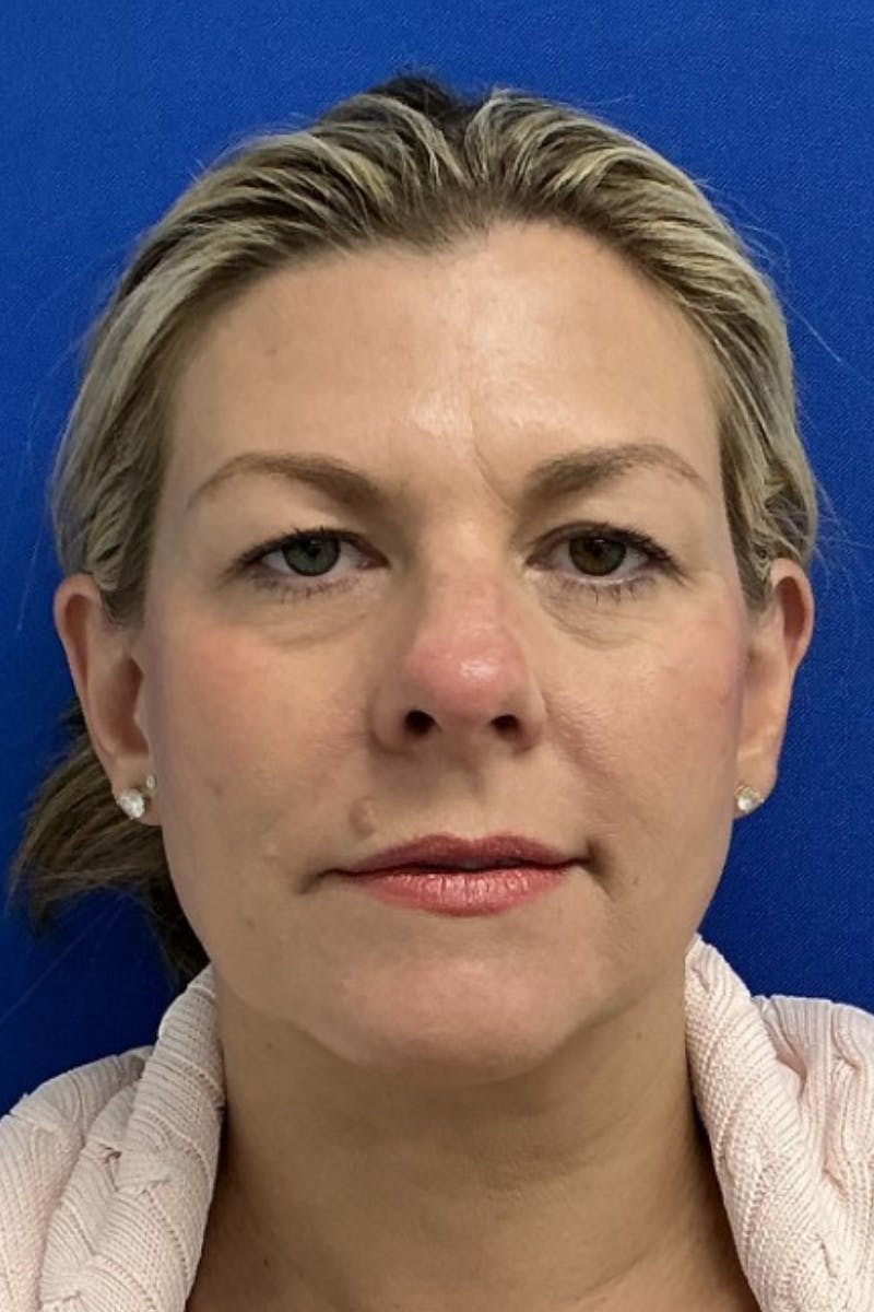 Blepharoplasty Before & After Gallery - Patient 107288 - Image 1