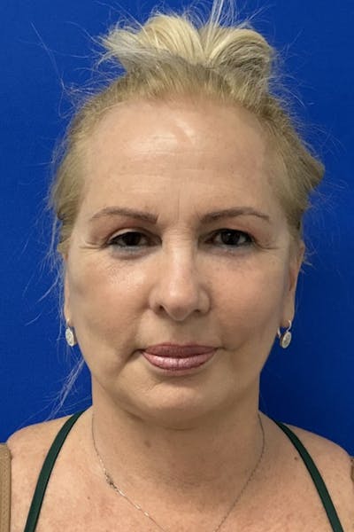 Blepharoplasty Before & After Gallery - Patient 115739 - Image 2