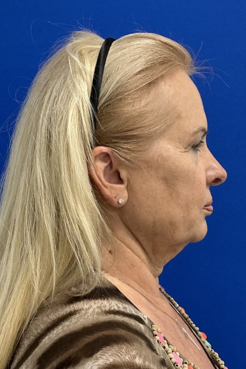 Facelift Before & After Gallery - Patient 287497 - Image 3