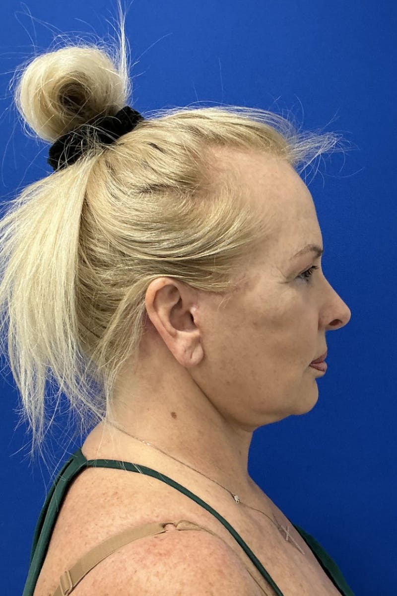 Facelift Before & After Gallery - Patient 287497 - Image 4