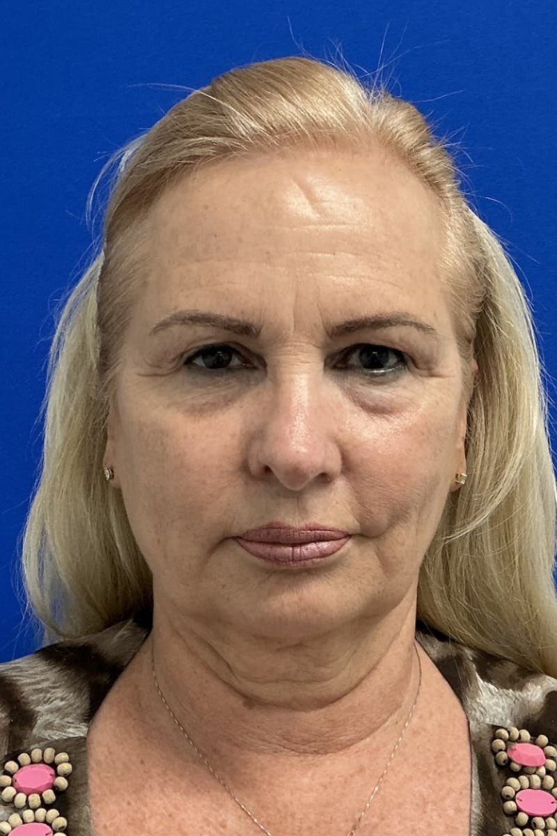 Blepharoplasty Before & After Gallery - Patient 115739 - Image 1