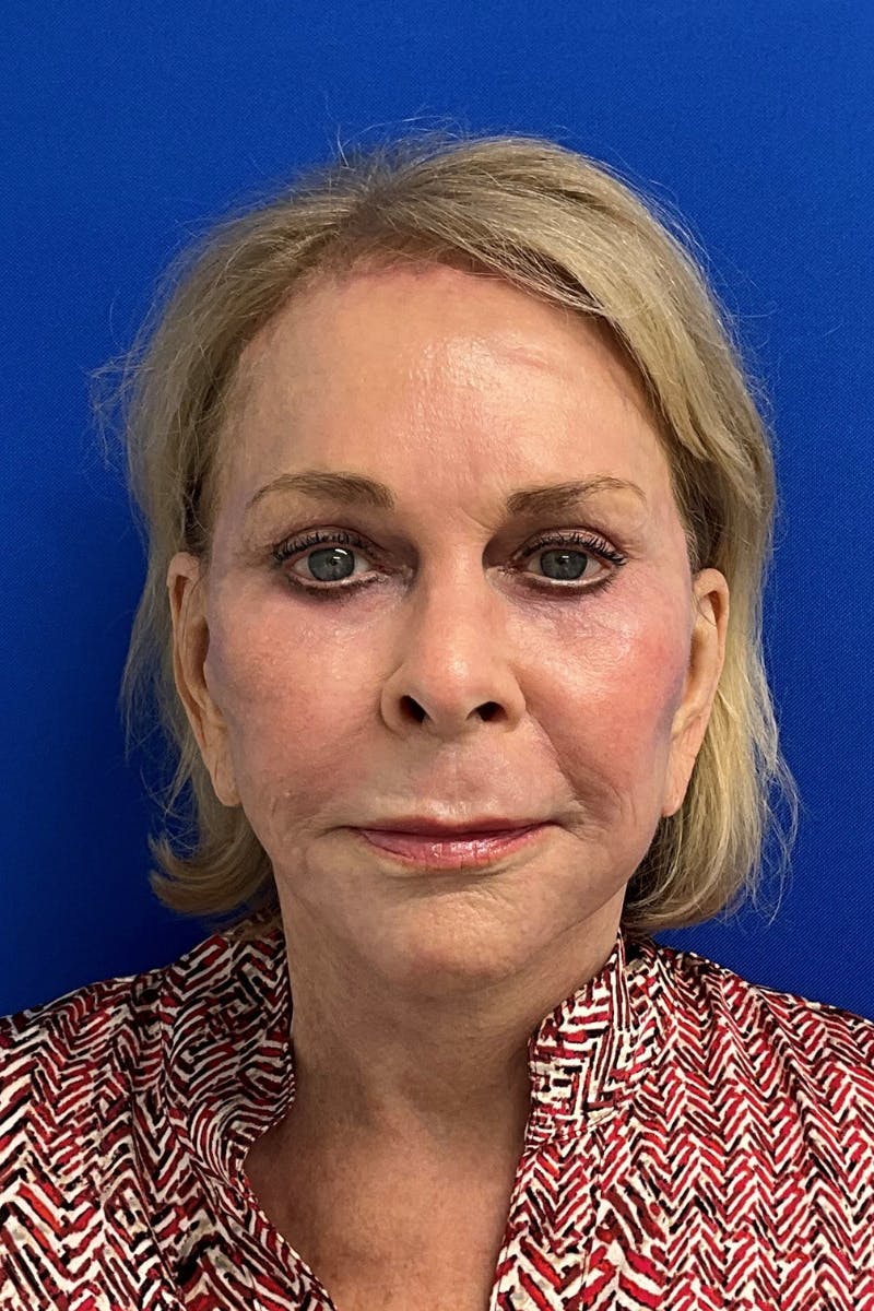 Blepharoplasty Before & After Gallery - Patient 336661 - Image 2