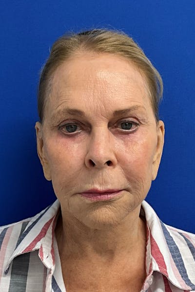 Blepharoplasty Before & After Gallery - Patient 336661 - Image 1