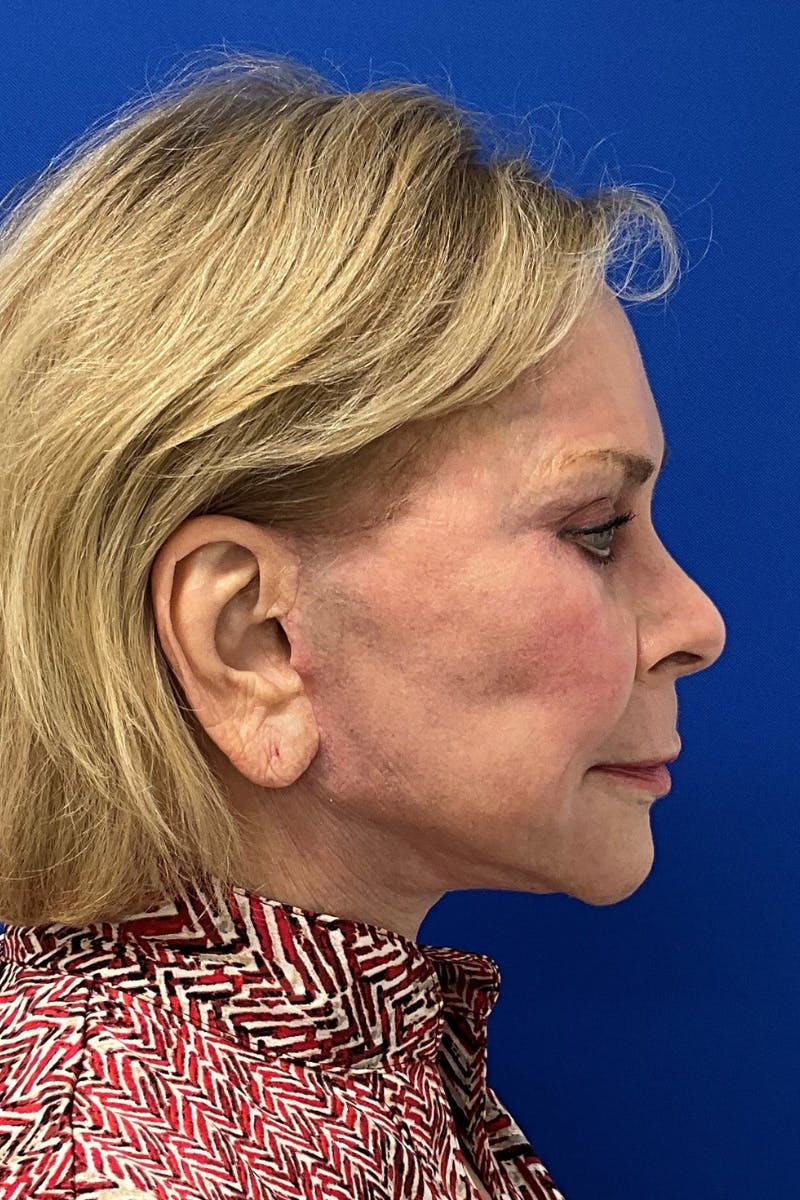 Facelift Before & After Gallery - Patient 115059 - Image 4