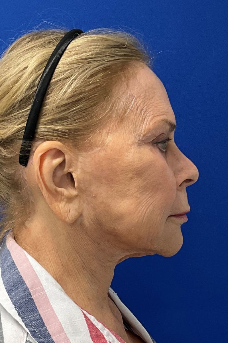 Facelift Before & After Gallery - Patient 115059 - Image 3