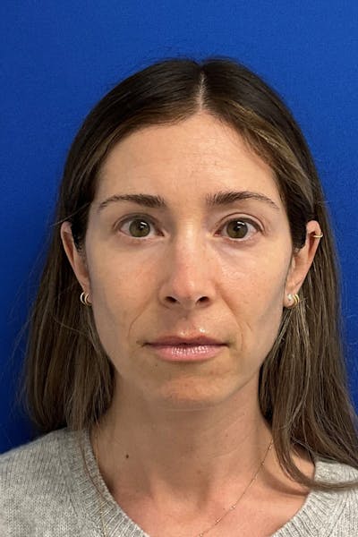 Blepharoplasty Before & After Gallery - Patient 127946 - Image 2