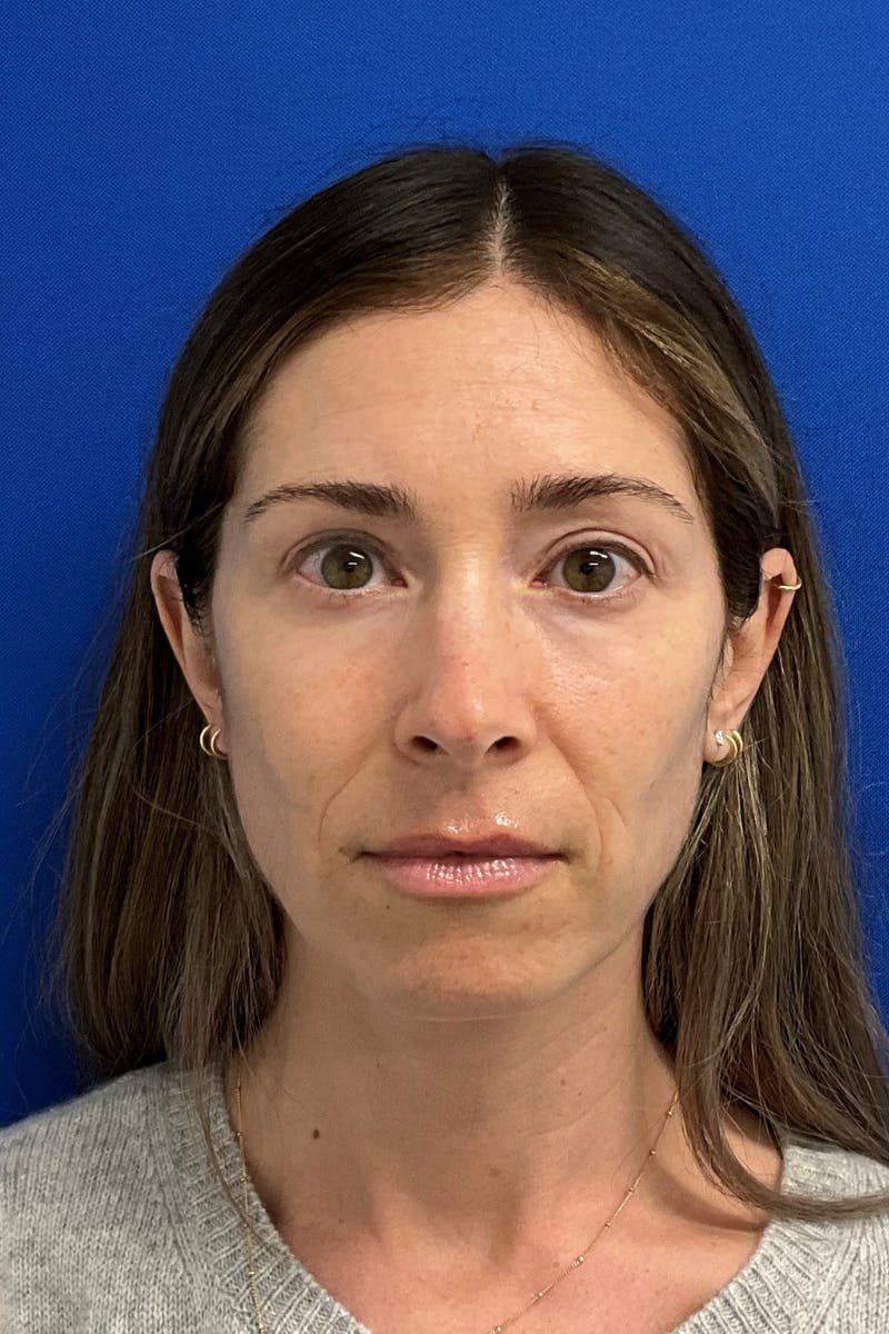 Blepharoplasty Before & After Gallery - Patient 127946 - Image 2