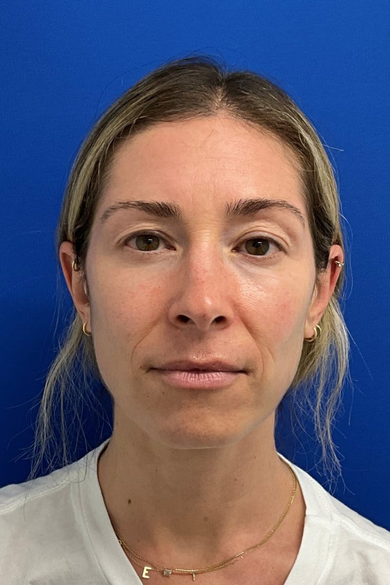 Blepharoplasty Before & After Gallery - Patient 127946 - Image 1